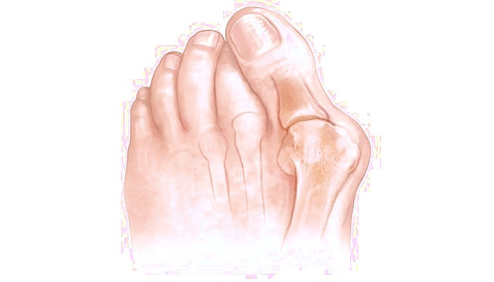 عمل هالوکس والگوس