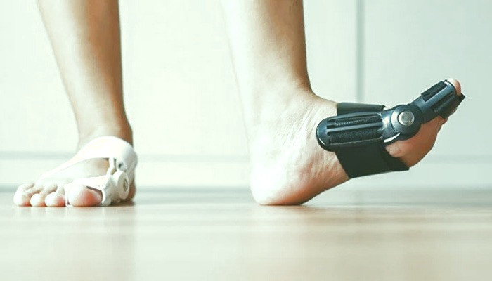 جراحی هالوکس والگوس