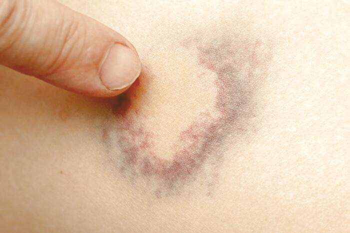 درمان زخم تازه