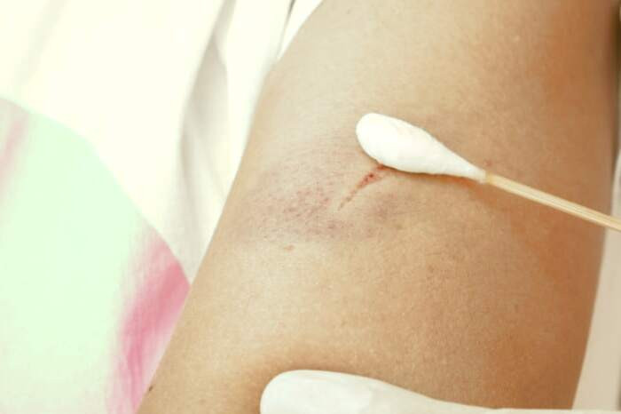 بهبود زخم سطحی