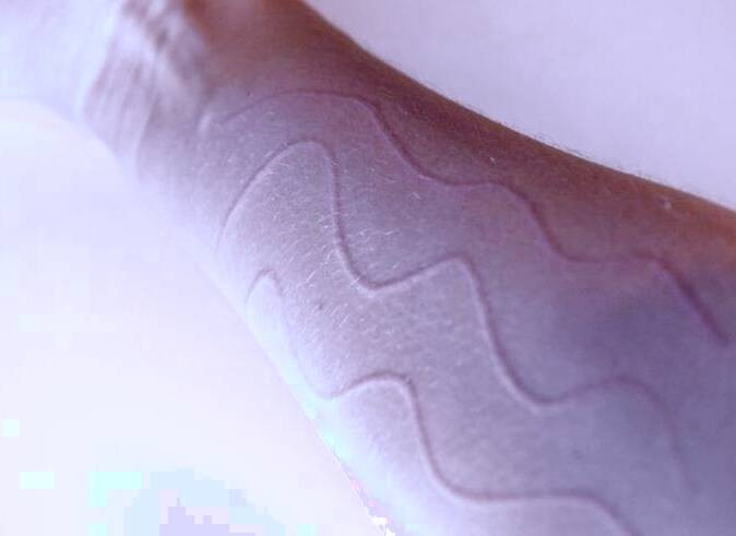 درماتوگرافی سفید