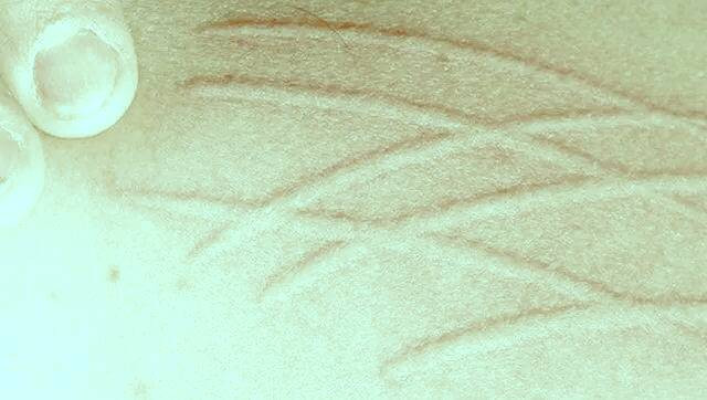 درماتوگرافی