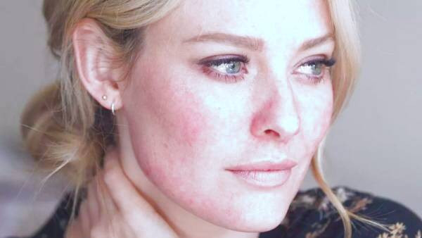 بیماری روزاسه چیست