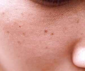 بهبود لکه های کبدی با درمان های گیاهی و طبیعی در خانه + ماسک