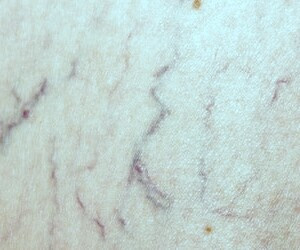 واریس تار عنکبوتی - اطلاعات جامع و راهنمای کامل