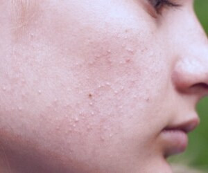 عوامل و راه حل های سریع برای جوش های ناشی از غرور جوانی در صورت و بدن با طب سنتی