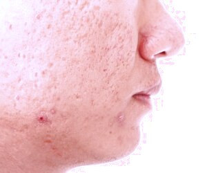 بررسی نکات کلیدی در مورد آکنه صورت