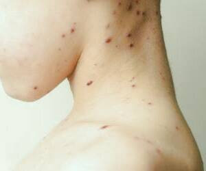 بررسی علل و نشانه‌های زونا در کودکان و راهکارهای درمان خانگی گیاهی