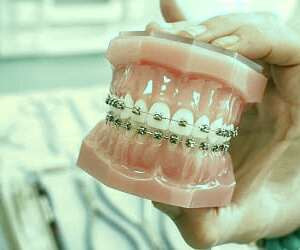 چه مدت زمان لازم است برای درمان ارتودنسی؟