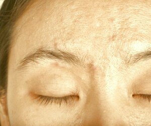 بررسی انواع داروهای ضد جوش و عوارض احتمالی آنها