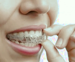 بهبود ظاهر دندان ها برای چهار دسته خاص