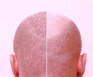 کاشت مو - راهنمای جامع برای کاشت مو با روش FIT