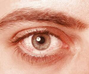 تغییر در رطوبت چشم و دهان نشانه های سندرم شوگرن