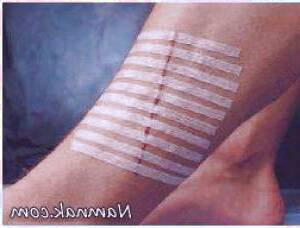 بررسی چسب جایگزین بخیه و مزایای آن