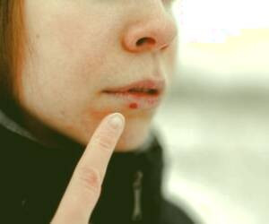 بهبود سریع تبخال لب با 32 روش درمانی گیاهی سنتی + دلایل