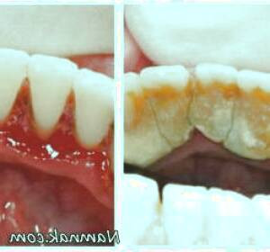 تارتار و پلاک دندان: راهکارهای خانگی برای رفع آن