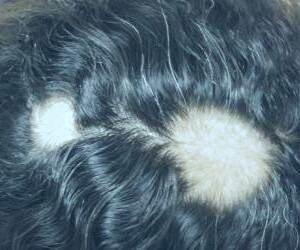 زمینه‌های کچلی سکه‌ای و ریزش مو + راهکارهای درمانی