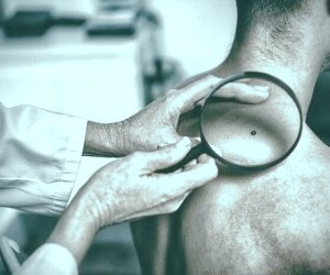آیا لکه های پوستی نشانه سرطان هستند؟