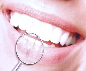 بهترین سن برای ایمپلنت دندان