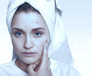 راهنمایی‌های ساده و کاربردی برای درمان جوش صورت