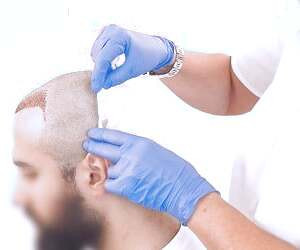 عوارض کاشت مو: نکاتی که پزشکان ممکن است به شما نگویند