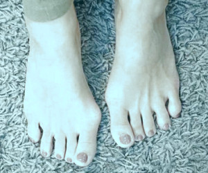 آیا جراحی هالوکس والگوس یک عمل دشوار است؟