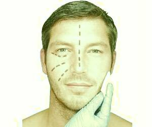 مراقبت‌های ضروری پس از لیفت صورت: راهنمای کامل