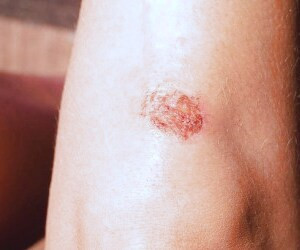 15 روش گیاهی برای درمان زخم‌های سطحی در منزل