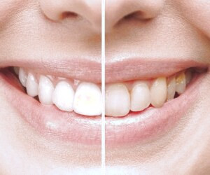 تعداد دفعات لازم برای جرم گیری دندان در سال چقدر است؟