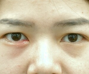 چگونه از شر گل مژه خلاص شویم؟ راهنمایی برای کاهش ناراحتی