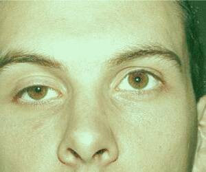 بررسی دلایل افتادگی پلک و راهکارهای درمانی شامل جراحی و تمرینات ویژه