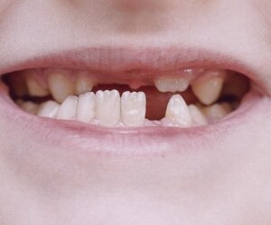 رشد نامنظم دندان های دائمی: چگونه از آن پیشگیری کنیم