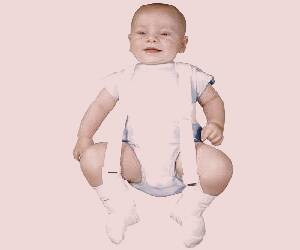 بررسی علائم و درمان دررفتگی مادرزادی لگن