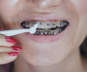 نکات مهم در نگهداری از دندان های ارتودنسی شده